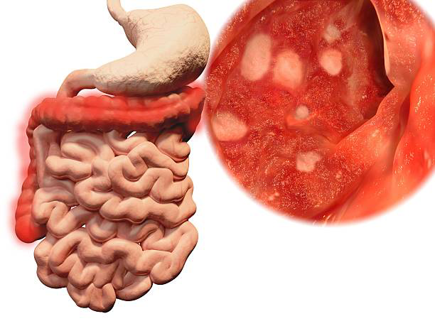 التهاب القولون التقرحي (Ulcerative colitis)