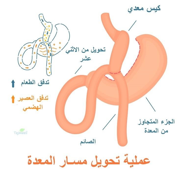 جراحات السمنة
